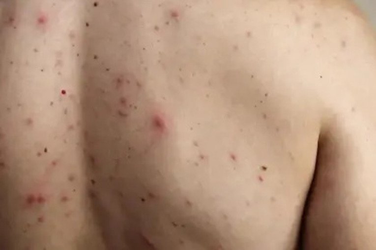 Sedes La Paz contabiliza 12 casos de sarampión, entre ellos un niño de ocho años 17425765719602 101 12285471 20250621 101 12544798 20250719213347 1