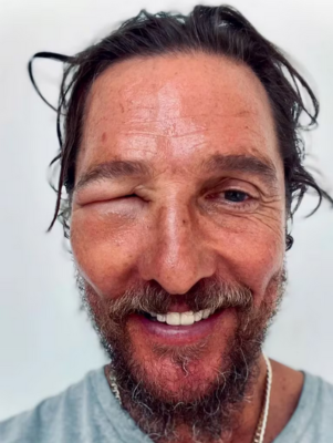 Screenshot 2024 07 12 at 10 27 24 Matthew McConaughey fue picado por una abeja en la cara y su foto se hizo viral Infobae