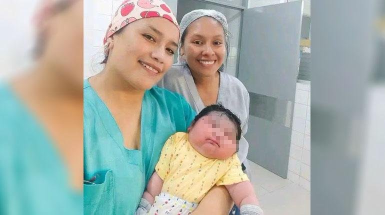 Nace en Beni una bebé de 6,850 kilos tras cesárea de emergencia bebe 2