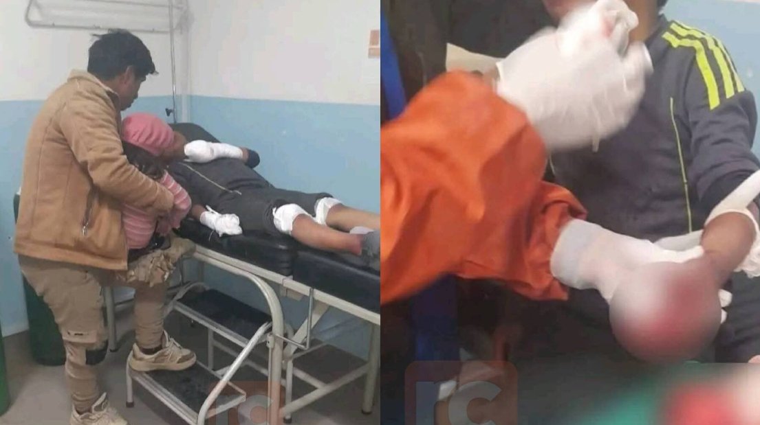 Un niño perdió cuatro dedos por explosión de una ‘bomba molotov’ durante bloqueos en El Alto el ministro de economia asegura que jamas se ha hablado de un control de divisas 1251190 7