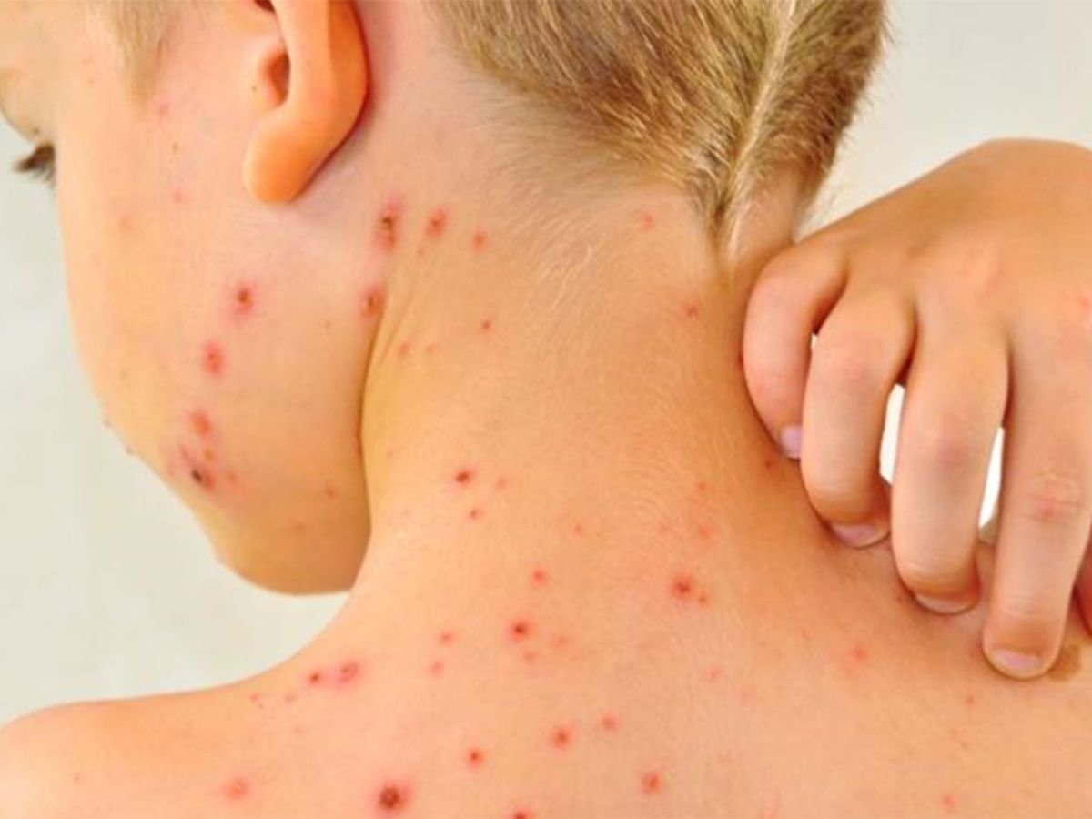 Sarampión en Bolivia: Ministerio de Salud reporta 205 casos hasta este domingo sarampion ninos 1.jpg 1902800913 1